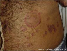 Psoriasis-onTreatment